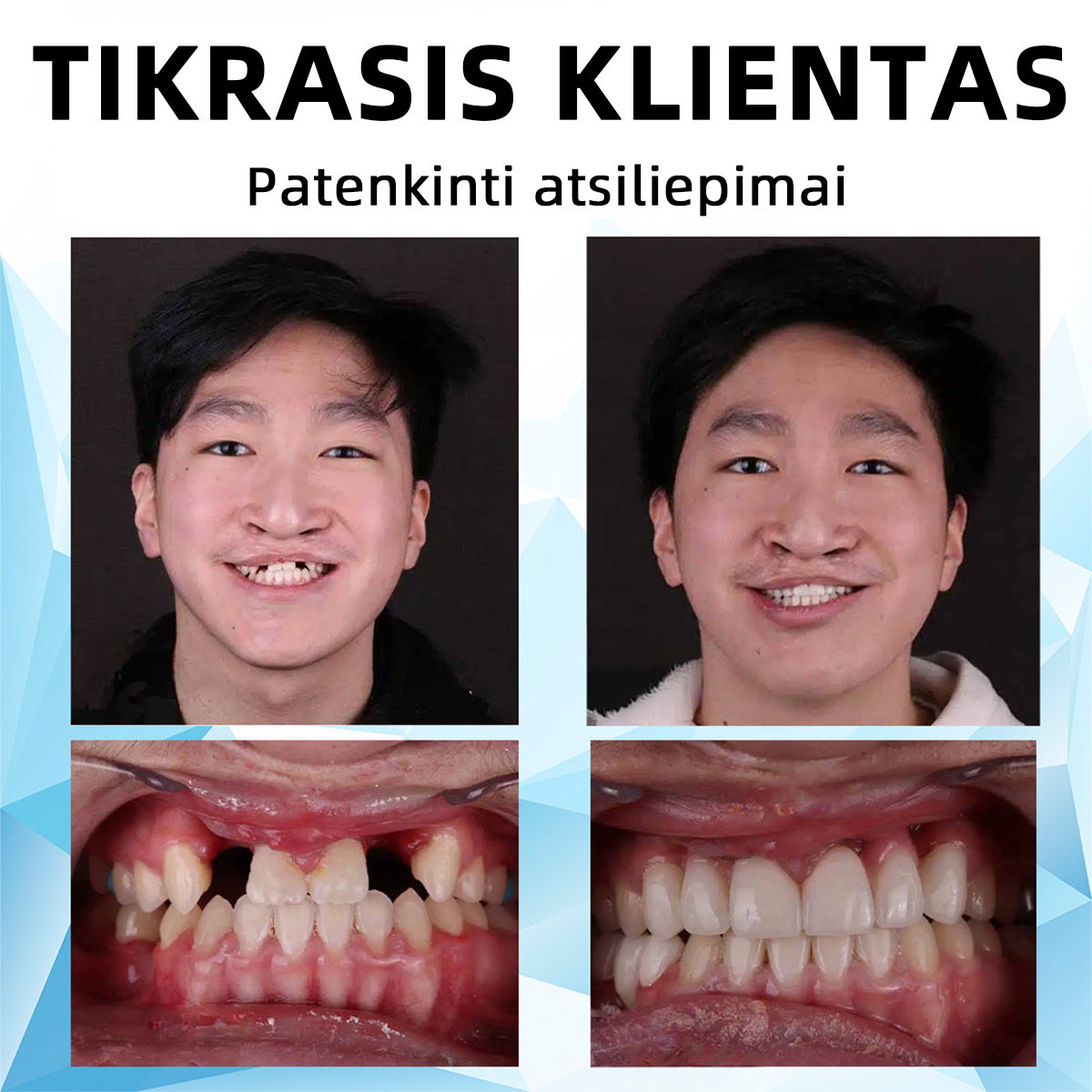 𝐁𝐢𝐤𝐞𝐧𝐝𝐚™Silikono pamušalo dantų protezų rinkinys🔥 (⏰𝑆𝑢𝑚𝑎ž𝑖𝑛𝑡𝑎𝑠 𝑛𝑢𝑜𝑙𝑎𝑖𝑑ų 𝑙𝑖𝑚𝑖𝑡𝑎𝑠, 𝑡𝑎𝑖𝑘𝑜𝑚𝑎𝑠 30 𝑚𝑖𝑛𝑢č𝑖ų⏰) 🦷👩⚕️