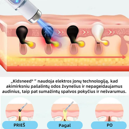 KIDSNEED®💃 neinvazinis apgamų ir karpų šalinimo lazerinis rašiklis – Galingas🔥🔥🔥Lietuvos Medicinos Sąjungos (LMS) rekomendacija