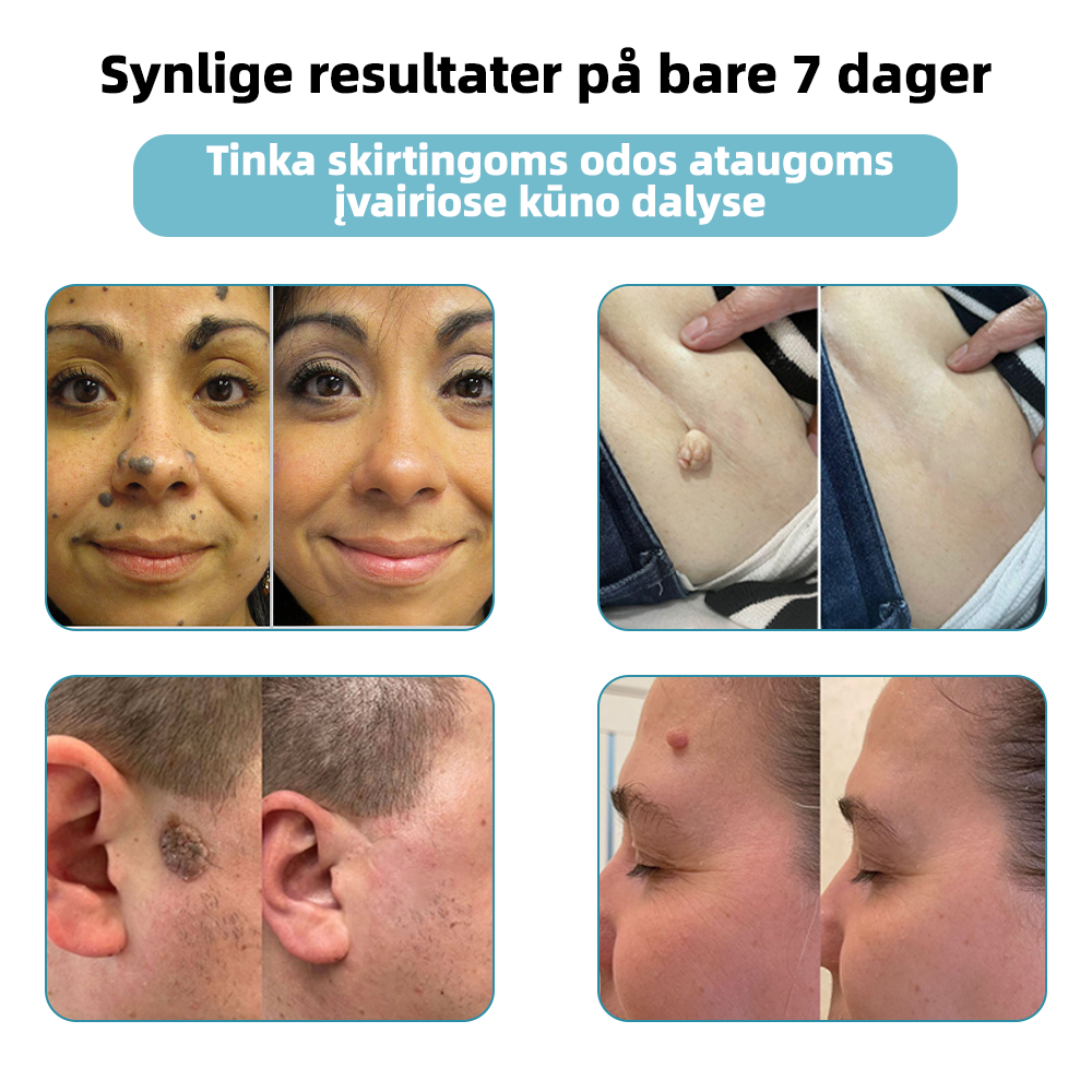 KIDSNEED®💃 neinvazinis apgamų ir karpų šalinimo lazerinis rašiklis – Galingas🔥🔥🔥Lietuvos Medicinos Sąjungos (LMS) rekomendacija