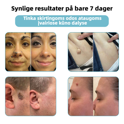 KIDSNEED®💃 neinvazinis apgamų ir karpų šalinimo lazerinis rašiklis – Galingas🔥🔥🔥Lietuvos Medicinos Sąjungos (LMS) rekomendacija