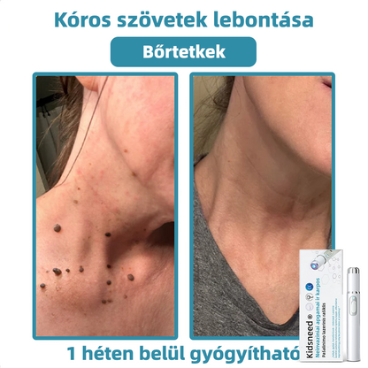 KIDSNEED®💃 neinvazinis apgamų ir karpų šalinimo lazerinis rašiklis – Galingas🔥🔥🔥Lietuvos Medicinos Sąjungos (LMS) rekomendacija