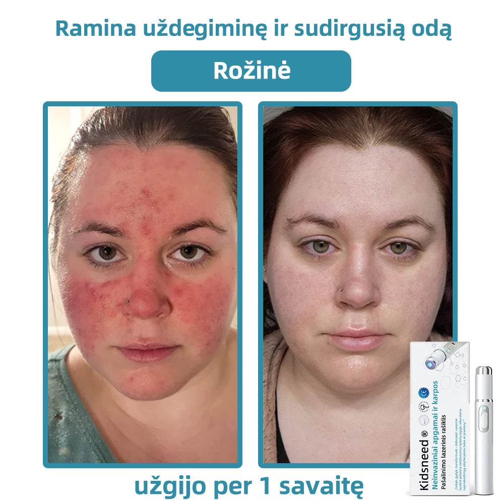 KIDSNEED®💃 neinvazinis apgamų ir karpų šalinimo lazerinis rašiklis – Galingas🔥🔥🔥Lietuvos Medicinos Sąjungos (LMS) rekomendacija
