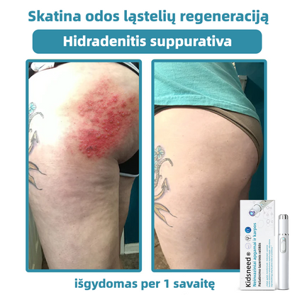 KIDSNEED®💃 neinvazinis apgamų ir karpų šalinimo lazerinis rašiklis – Galingas🔥🔥🔥Lietuvos Medicinos Sąjungos (LMS) rekomendacija